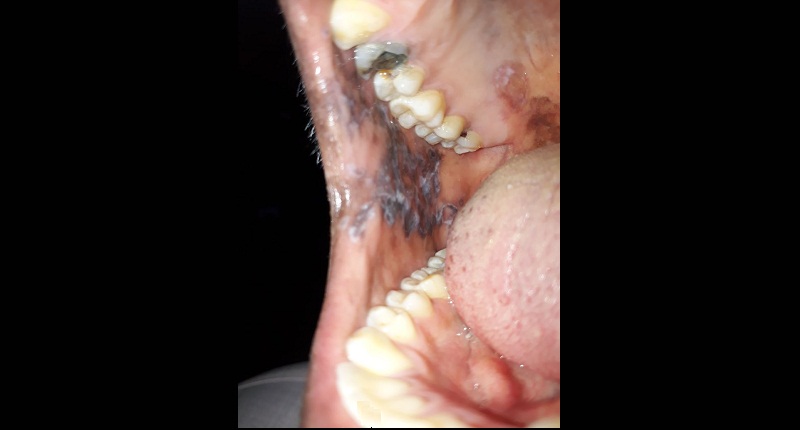 white lesions of oral cavity treatment in pune